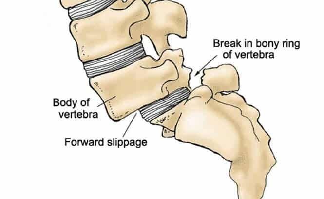 Spondylolisthesis