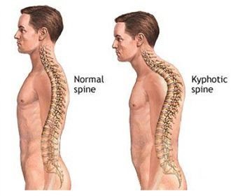 Kyphosis (Hunchback)